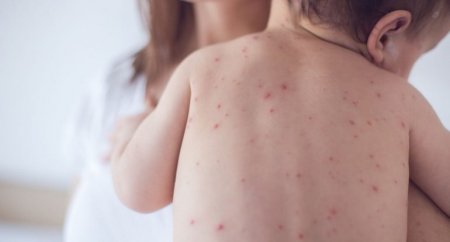 Yoluxucu virus infeksiyası olan qızılca, xüsusilə uşaqlar arasında ciddi sağlamlıq riski yaradır. 